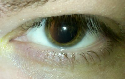 Dilated left eye on Wednesday