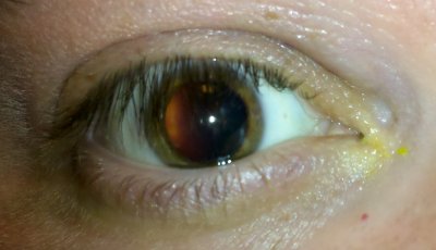 Dilated right eye on Friday