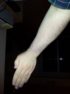 My wrist on April 1, 2012