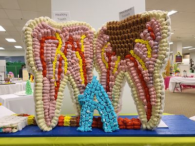 Display from a dentist's office, showing a healthy tooth vs. a decayed tooth.